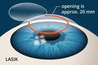 What's the Difference between SMILE and LASIK Eye Surgery?