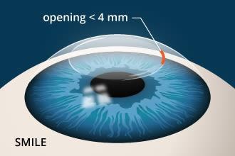 You are currently viewing What’s the Difference between SMILE and LASIK Eye Surgery?